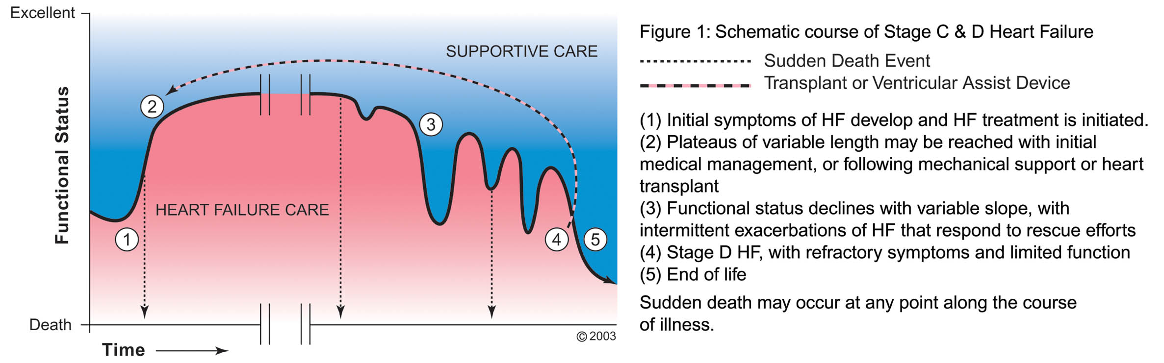 Chart of the course of heart failure, with physical function worsening at the time of diagnosis, improving with heart failure treatment and then worsening as the illness progresses